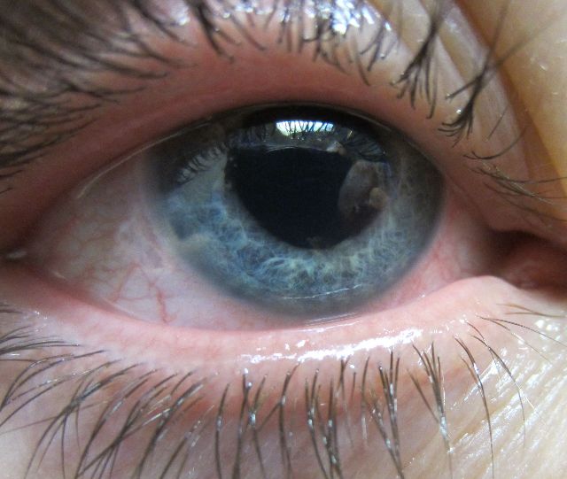 Close-up photograph of an eyelid with visible trauma. Text on the image reads 'IMG-9511'.